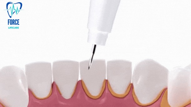 Why Dental Cleanings Are Essential